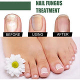 Nail Fungus Treatment