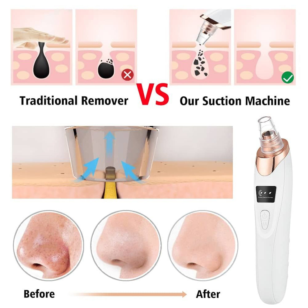 5 in 1 Blackhead remover | Derma Suction  | Rechargeable